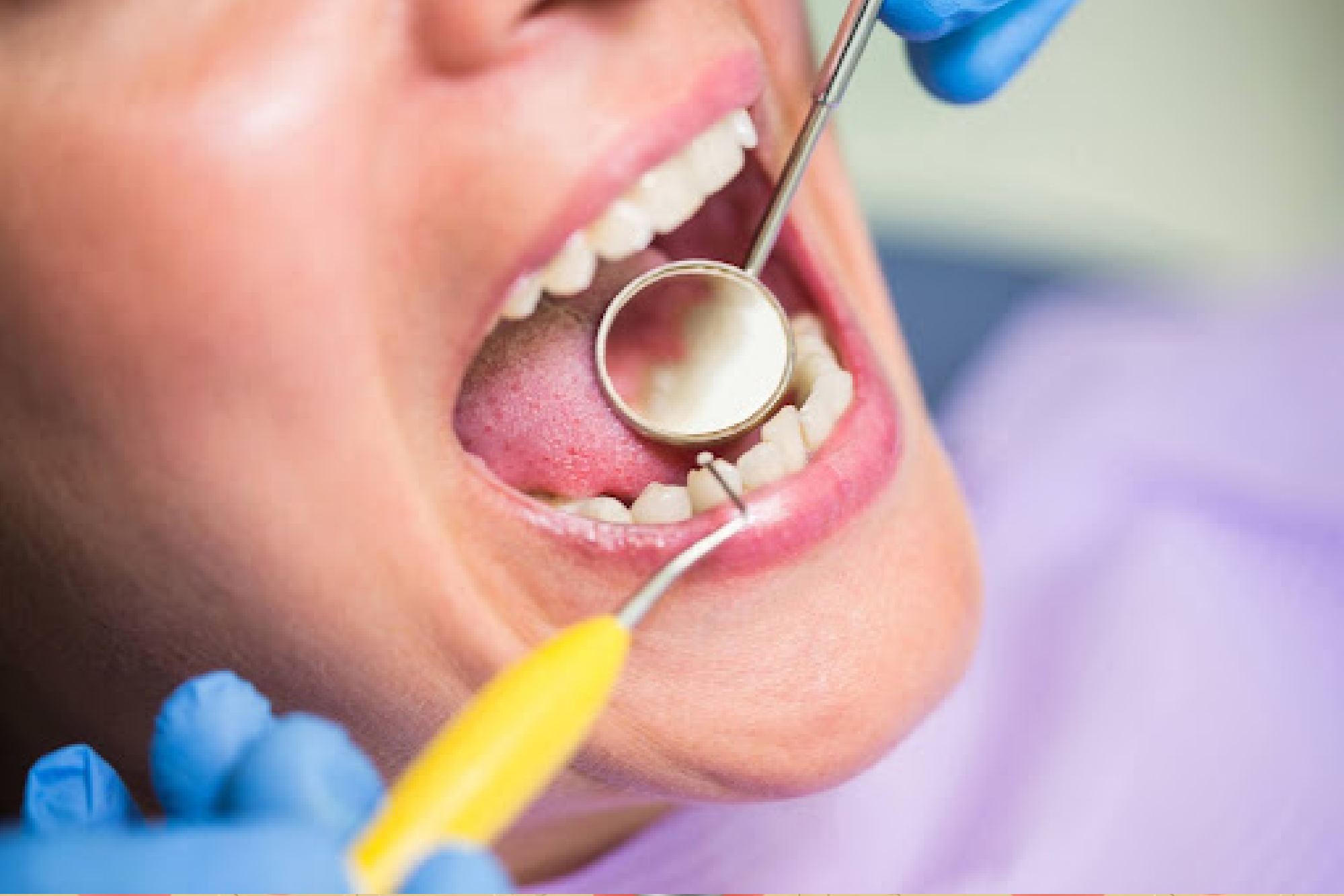 Dental Fillings in Brookefield, Bangalore