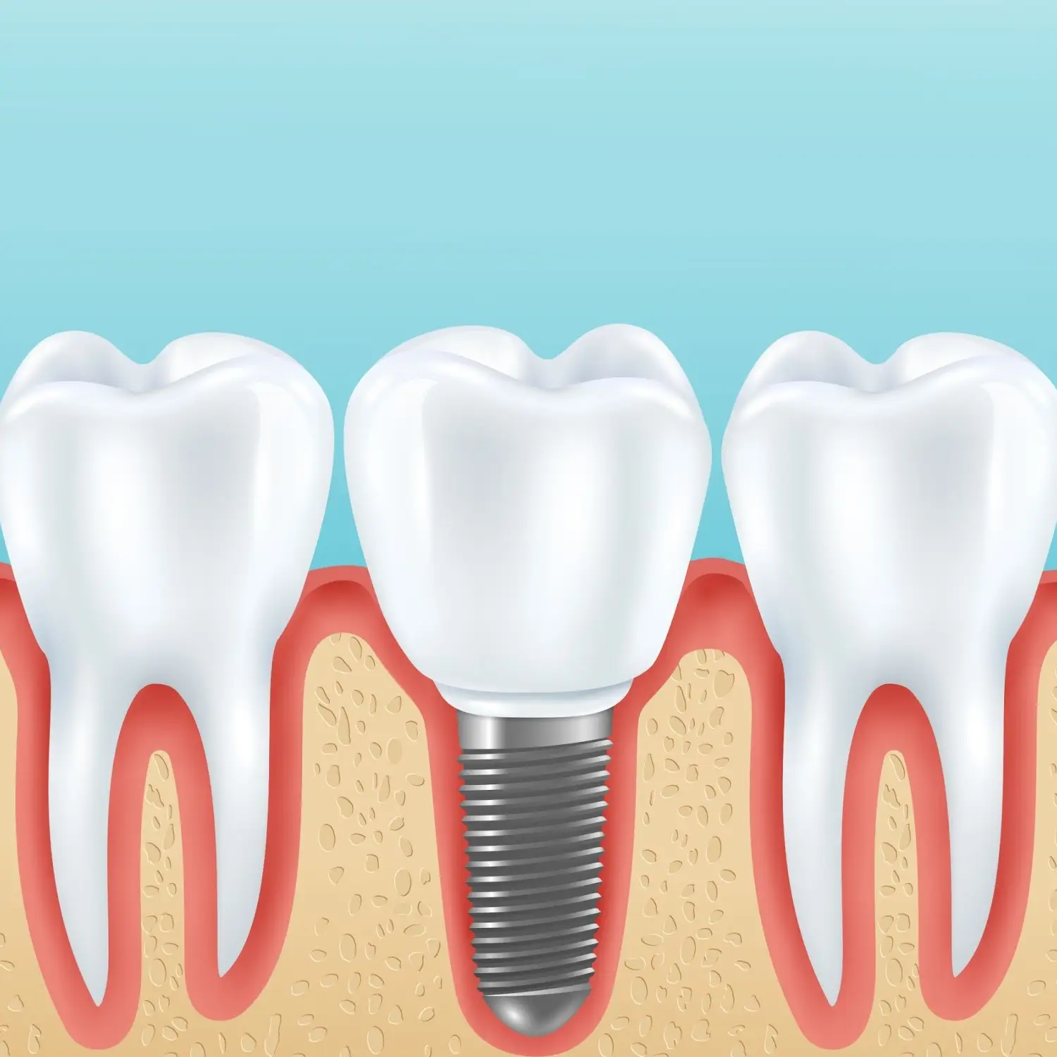 Dental Implants in Brookefield, Bangalore